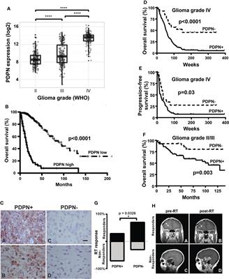 PDPN marks a subset of aggressive and radiation-resistant glioblastoma cells